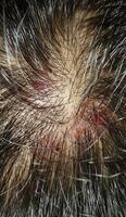 Scabs On The Scalp, wound on the scalps or Lichen planus follicularis capillitii, itch on the scalps photo