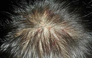 Scabs On The Scalp, wound on the scalps or Lichen planus follicularis capillitii, itch on the scalps photo