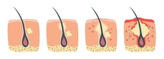 Stages of the hair follicle inflammation in the human skin. The sebum in the clogged pore promotes the growth of a bacteria. This leads to the redness and inflammation, that associated with pimples. vector