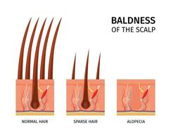 Scalp Baldness Structure Composition vector