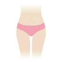 tramo marcas en barriguita vector ilustración aislado en blanco antecedentes. el blanco tramo marcas Aparecer en el abdomen, medio estómago, barriga de mujer cuerpo. piel cuidado y belleza concepto.