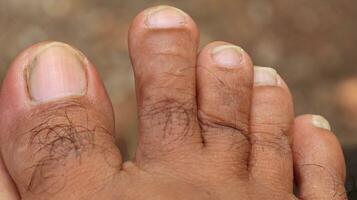 Close up of male foot and dirty long toe nail photo