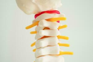 Spinal nerve and bone, Lumbar spine displaced herniated disc fragment, Model for treatment medical in the orthopedic department. photo