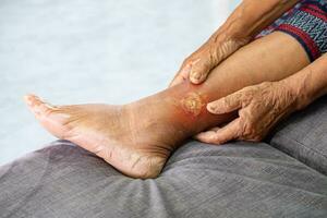 Asian elderly woman holding hands on her leg with gangrene due to diabetes, health care concept and occupational health photo