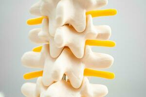 Lumbar spine displaced herniated disc fragment, spinal nerve and bone. Model for treatment medical in the orthopedic department. photo