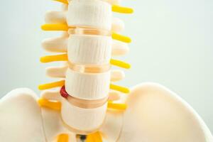 Lumbar spine displaced herniated disc fragment, spinal nerve and bone. Model for treatment medical in the orthopedic department. photo