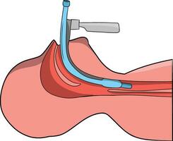 un mano dibujado ilustración de un médico endotraqueal intubación vector