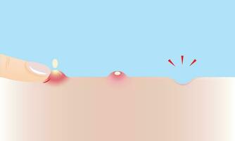 Step of squeeze acne to rolling scar vector illustration on sky blue background. The inflammatory acne, pustule on skin, squeeze pimple with finger to acne scar. Before and after skin care concept.