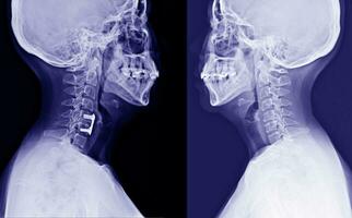 X-ray C-Spine Lateral normal views and Post operation spinal fixcation of C5-6 bodies Showing No spinal dislocation.Medical concept photo