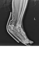 Film ankle X-ray radiograph showing heel bone broken close fracture calcaneus Medical technology and healthcare concept. photo