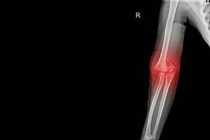 X-ray Elbow joint Finding Supracondylar fracture distal humerus with joint effusion.Medical image concept. photo