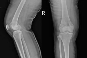 x-ray knee joint Views showing Osteosarcoma. photo
