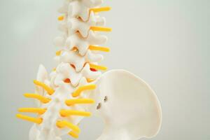 Spinal nerve and bone, Lumbar spine displaced herniated disc fragment, Model for treatment medical in the orthopedic department. photo