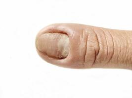 Fingers with nail fungus photo