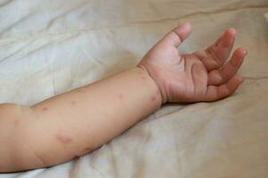 Red rash caused by infant arm infection photo