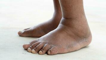 Side view of swollen feet on both sides. health problems of the elderly. Diabetes in the elderly and overweight. stand barefoot on the concrete floor. photo