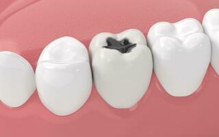 Tooth decay, unhealthy teeth, 3d rendering. photo