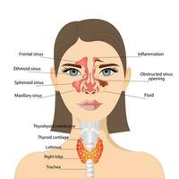 sinusitis, mujer cara con inflamación de el mucoso membrana de el paranasal y frontal senos paranasales. frente ver de el tiroides glándula y tráquea en un blanco antecedentes. humano cuerpo órganos anatomía vector