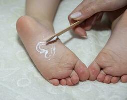 Children's atopic skin, moisturizing the skin with emollient cream, atopic dermatitis. photo