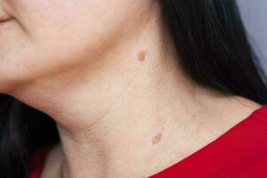 Birthmarks on skin Close up detail of the bare skin Sun Exposure effect on skin, Health Effects of UV Radiation Woman with birthmarks Pigmentation and lot of birthmarks. photo