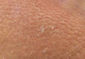 texture of the unhealthy human skin epidermis with flaky and cracked particles close up. photo
