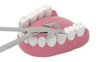 dra upp tand förfall, ohälsosam tänder, 3d tolkning. video