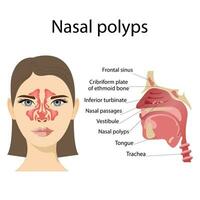 Medical vector illustration of nasal polyps. Non-cancerous neoplasms on the nasal mucosa or sinuses on a white background