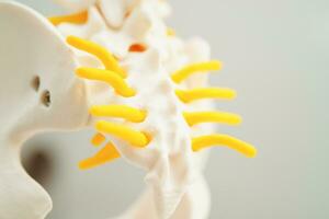 Spinal nerve and bone, Lumbar spine displaced herniated disc fragment, Model for treatment medical in the orthopedic department. photo
