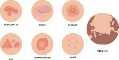 Different types of psoriasis vector set. Part of patients skin with dermatitis, inflammation, red rash and other skin problems vector illustration suitable for women's skin health problems