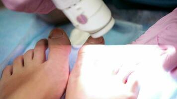 Podiatrist treating onychomycosis with a laser video