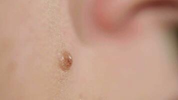 Macro shot of mole on human skin video