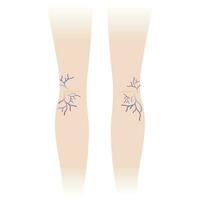 Varicose veins and spider veins on the woman legs vector illustration isolated on white background. Varicose and spider veins are swollen, twisted that become larger, making them show under the skin.