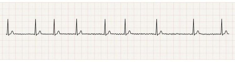 EKG Monitor Showing Atrial Fibrillation With Normal Ventricular Response vector