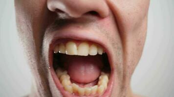 närbild, en man visar hans krokig gul och ohälsosam tänder. dental vård begrepp. video