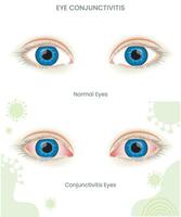 During Pink eye or eye conjunctivitis it shows Eye membrane inflammation, redness, irritation, and discharge vector