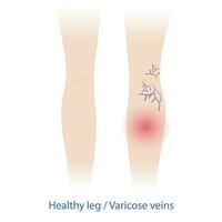 Comparison of healthy and varicose veins on the woman legs vector illustration isolated on white background. Varicose and spider veins are swollen, twisted and pain, making them show under the skin.