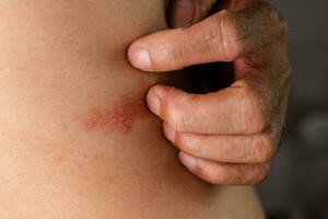 Man with shingles disease, skin infected with Herpes zoster, virus, Healthcare and medical. photo