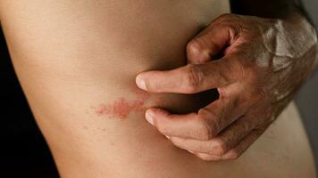 Man with shingles disease, skin infected with Herpes zoster, virus, Healthcare and medical. photo