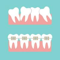 braces crooked teeth, straight teeth with braces vector