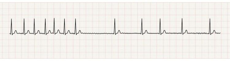 EKG Monitor Showing Atrial Fibrillation With Rapid Ventricular Response and Slower Rate After Adenosine Intravenous vector