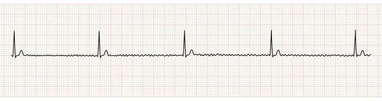 EKG Monitor Showing Regularized Atrial Fibrillation or AF with Block vector