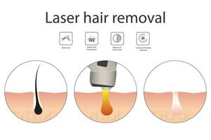 Laser hair removal concept with skin and hair areas. Stages of the removal procedure. Medical diagram before and after using a laser. Vector illustration