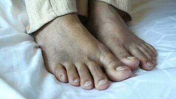 close up of women feet with swelling . video