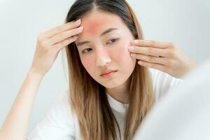 Young woman asian are worried about faces Dermatology and allergic to steroids in cosmetics. sensitive skin, red face from sunburn, acne, allergic to chemicals, rash on face. skin problems and beauty photo