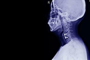 X-ray C-Spine Lateral views Post operation spinal fixcation of C5-6 bodies Showing No spinal dislocation.Medical concept photo