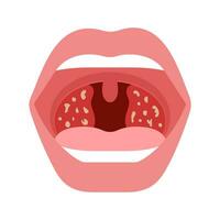 Pain in throat, tonsillitis of human. Open mouth with infection plugs, redness of tonsils. Inflammation airway, pain in throat. Vector illustration