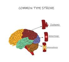 One common type of brain Stroke is characterized by brain tissue moving underneath the middle fold of the dura falx. This type is called a subalpine brain herniation vector