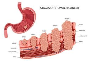 Stomach cancer. Stages growth malignant cancerous tumor. Anatomical vector illustration isolated white background cartoon style