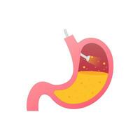 Stomach endoscopy. Endoscope in stomach through esophagus. Vector stock illustration