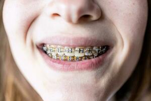 view of dental brackets on teeth of teenager photo